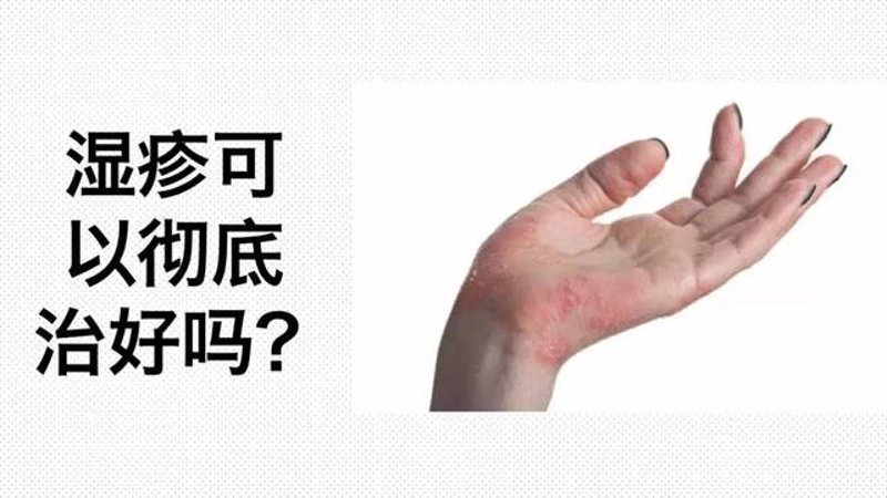 湿疹治疗选购指南