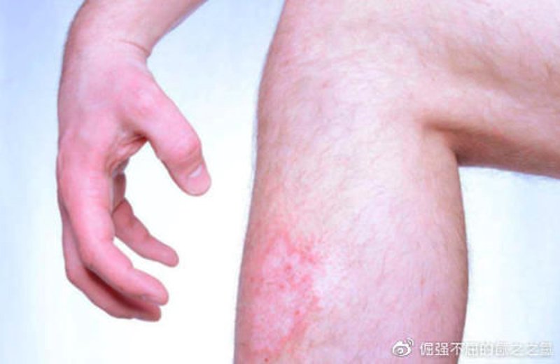 湿疹治疗